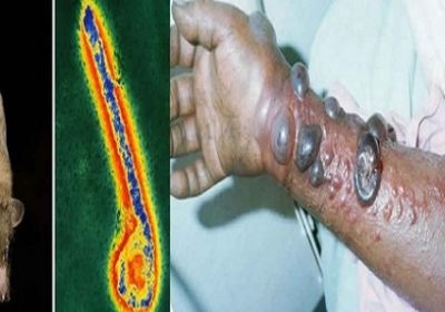 Guinée équatoriale : 2 nouveaux décès dans une épidémie de fièvre hémorragique de Marburg