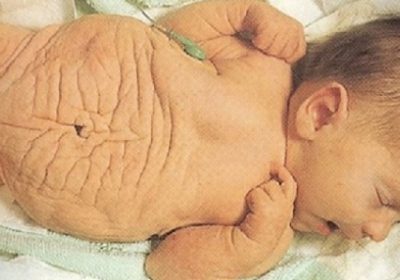 Journée mondiale des maladies rares : Zoom sur le syndrome de « Prune Belly”
